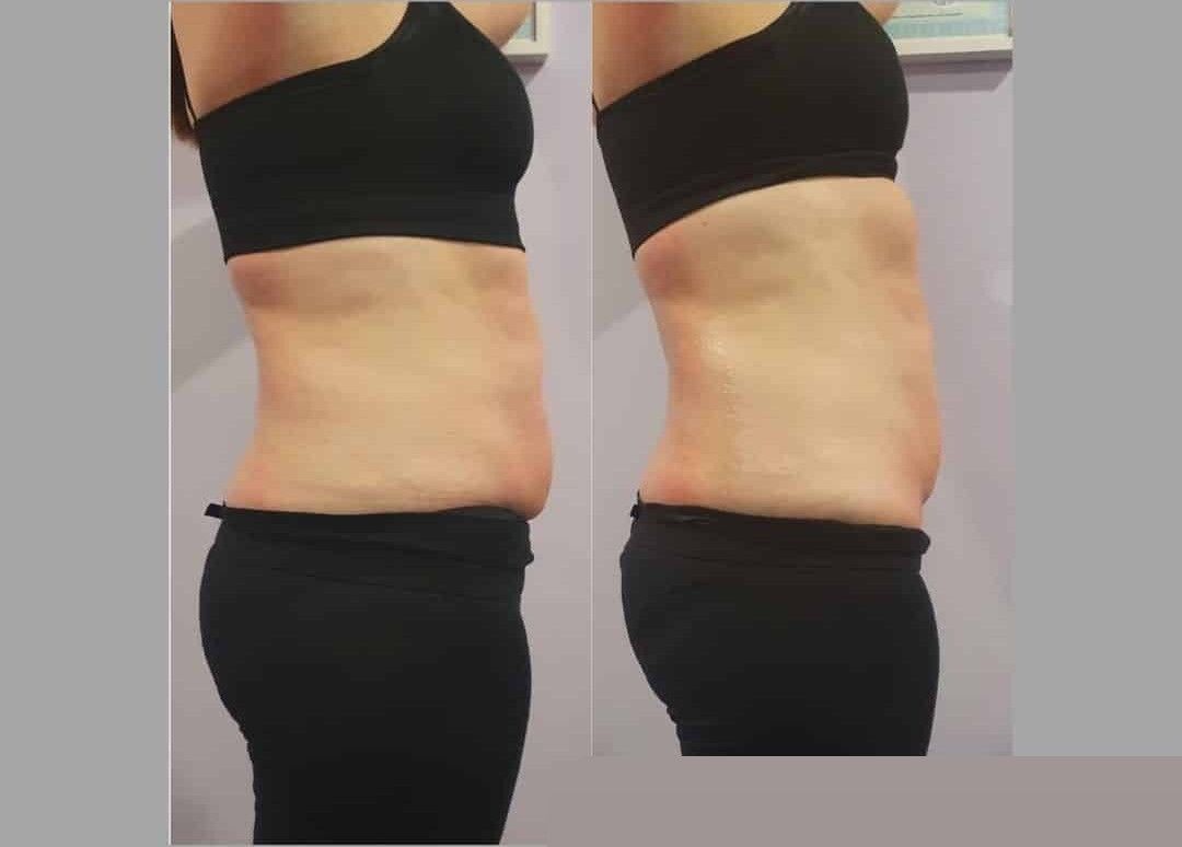 Fat Reduction before and after results