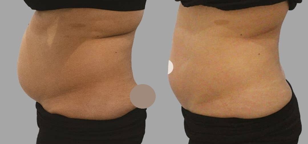Fat Reduction before and after results