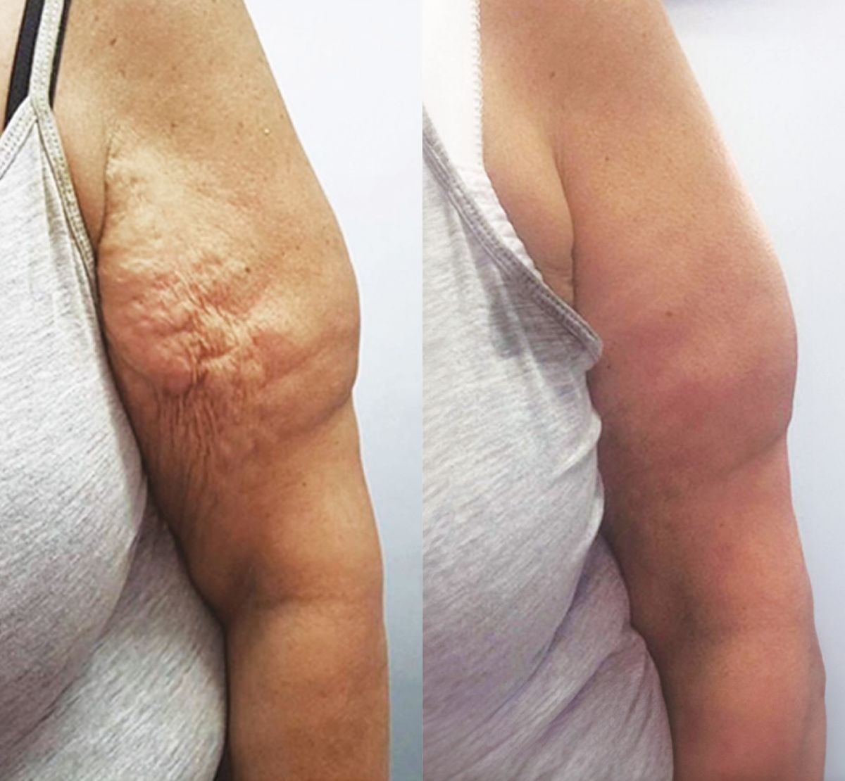 Body Contouring before and after results