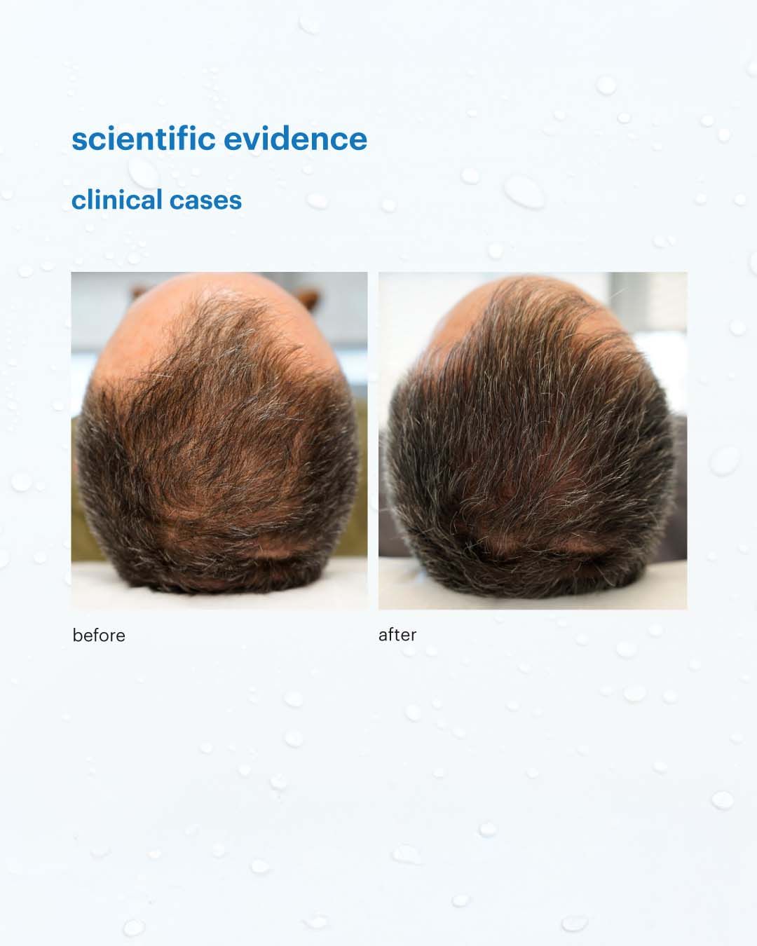 Hair Loss Treatment before and after results