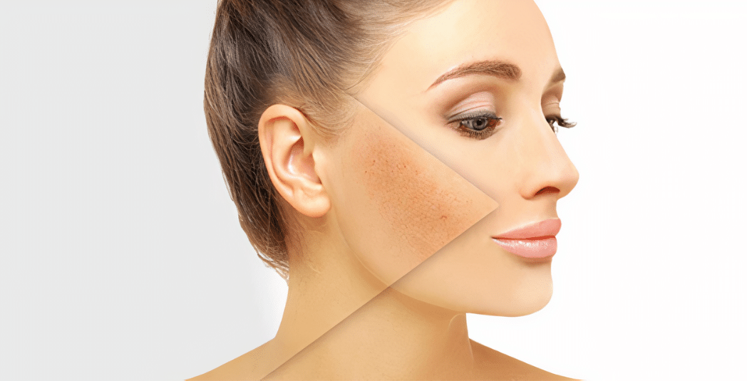 Pigmentation Removal